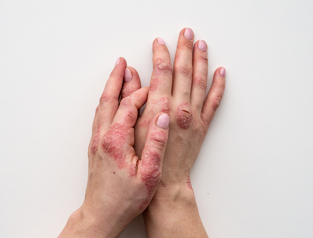 Eating for Your Joints: An Anti-Inflammatory Diet