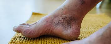 Top 12 Home Remedies for Nerve Pain (Neuropathy) in the Feet